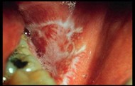 Oral lichen planus linked to dental mercury amalgam fillings