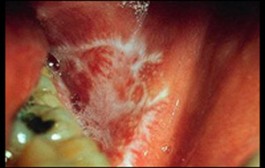 Oral lichen planus linked to dental mercury amalgam fillings