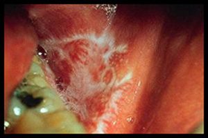 Oral lichen planus linked to dental mercury amalgam fillings