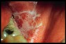 Oral lichen planus linked to dental mercury amalgam fillings