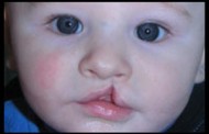 Mercury Amalgam Dental Fillings During Pregnancy Linked to Infant Cleft Palate