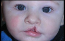 Mercury Amalgam Dental Fillings During Pregnancy Linked to Infant Cleft Palate