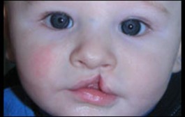 Mercury Amalgam Dental Fillings During Pregnancy Linked to Infant Cleft Palate