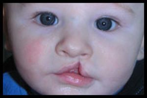 Mercury Amalgam Dental Fillings During Pregnancy Linked to Infant Cleft Palate
