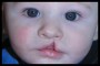Mercury Amalgam Dental Fillings During Pregnancy Linked to Infant Cleft Palate