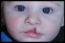 Mercury Amalgam Dental Fillings During Pregnancy Linked to Infant Cleft Palate