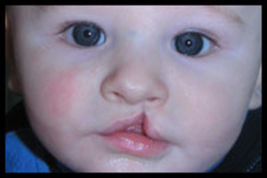 Mercury Amalgam Dental Fillings During Pregnancy Linked to Infant Cleft Palate